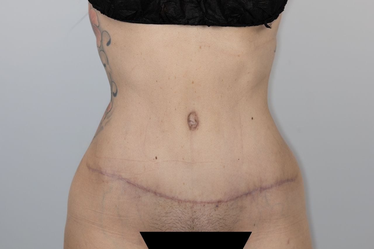 Tummy Tuck