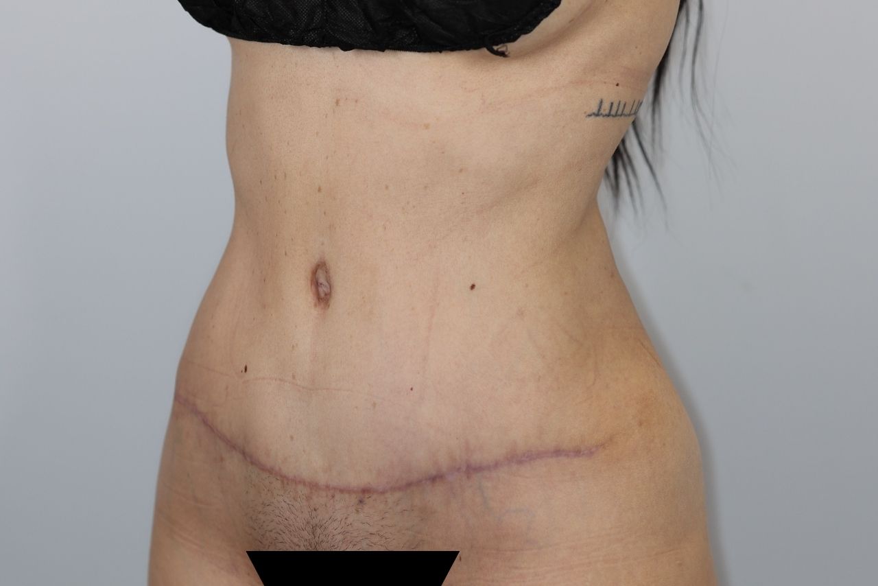 Tummy Tuck