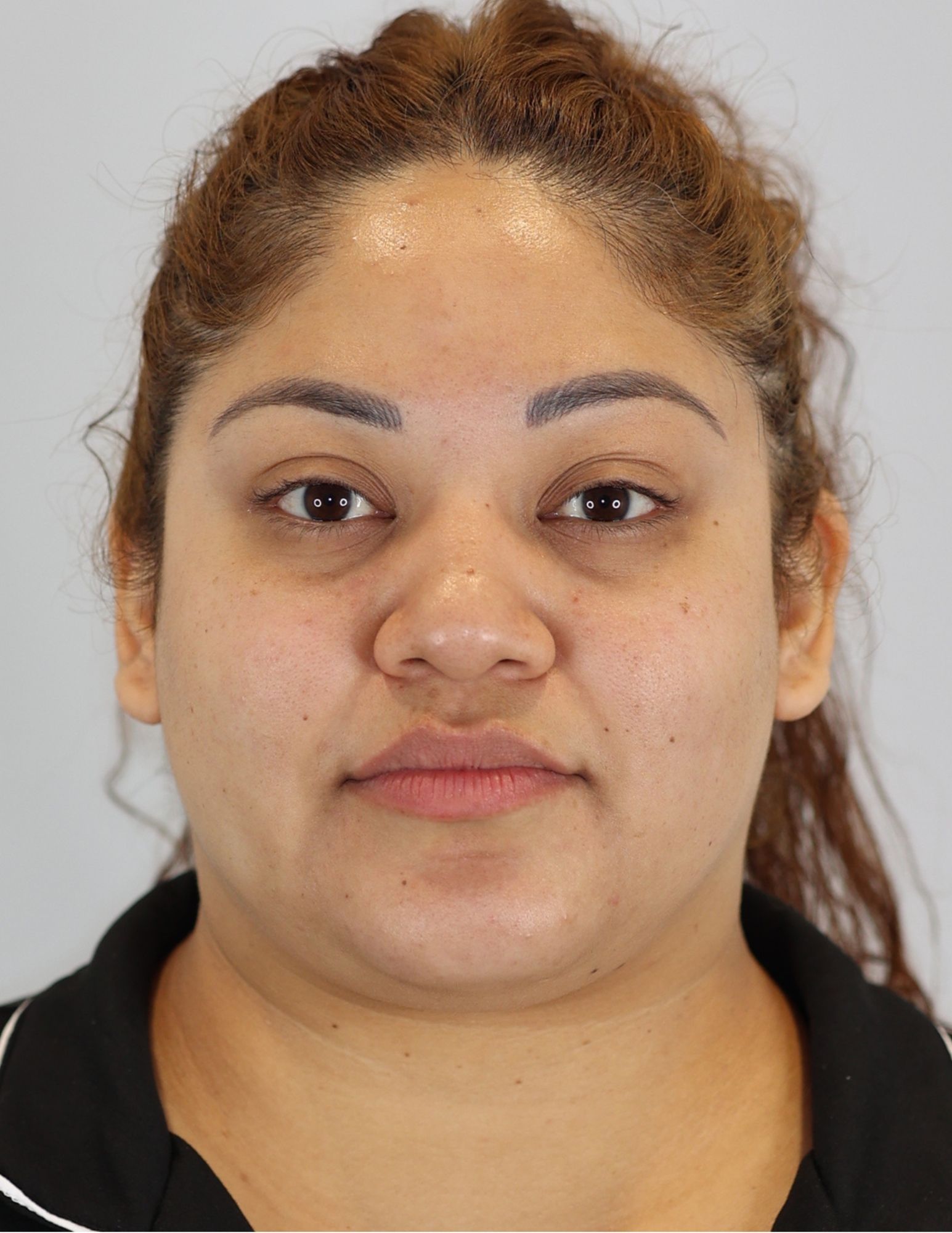 Neck (Chin) Liposuction