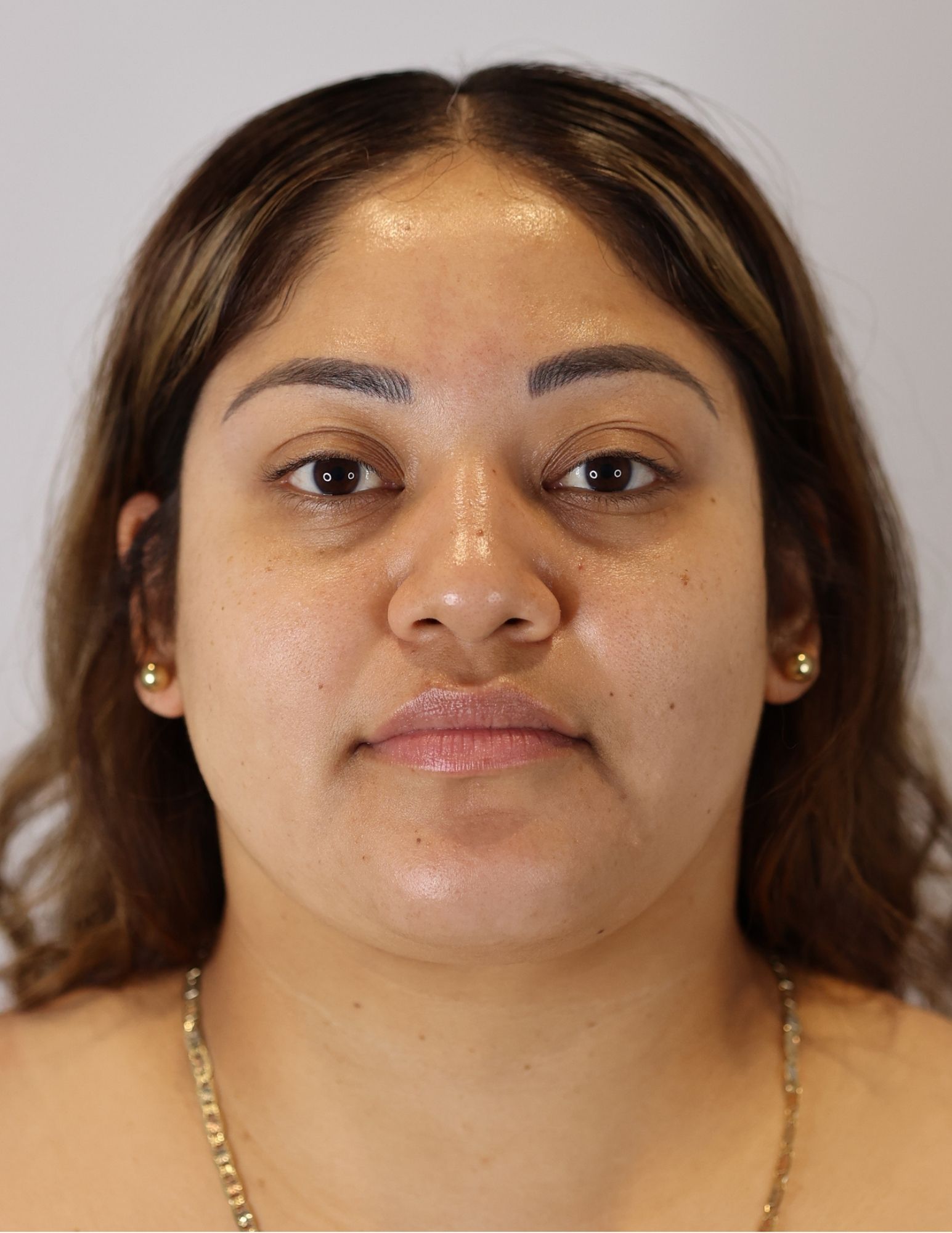 Neck (Chin) Liposuction