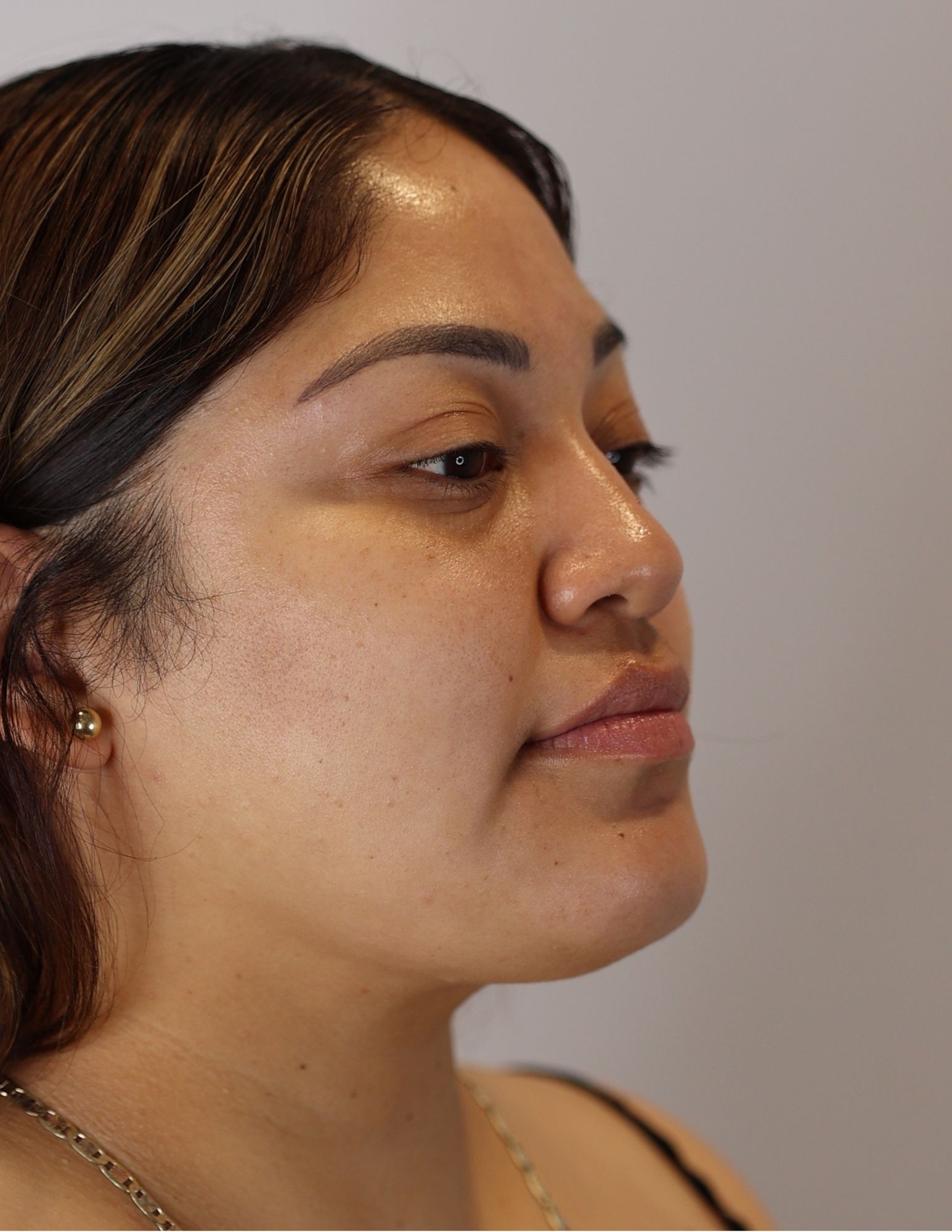 Neck (Chin) Liposuction