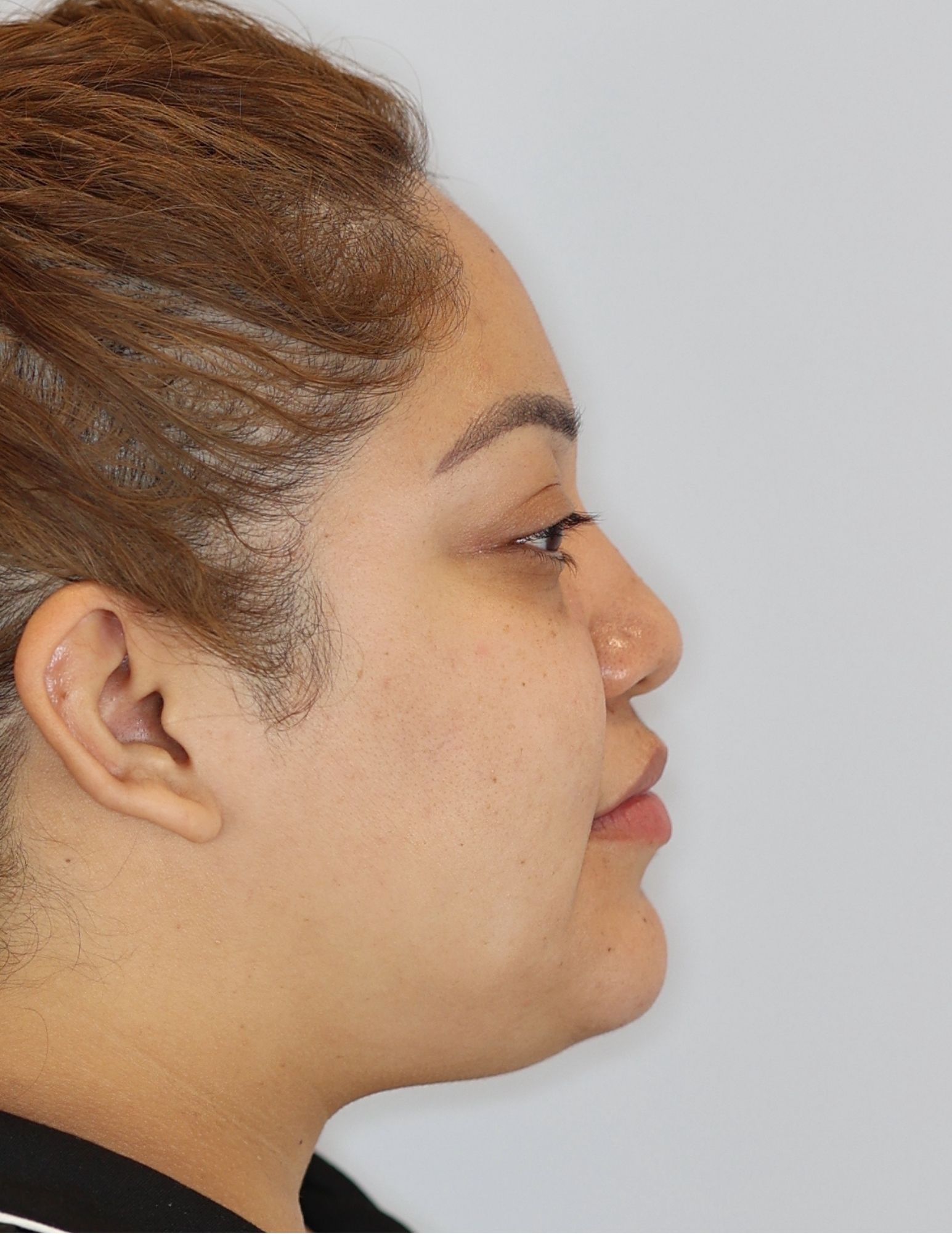Neck (Chin) Liposuction