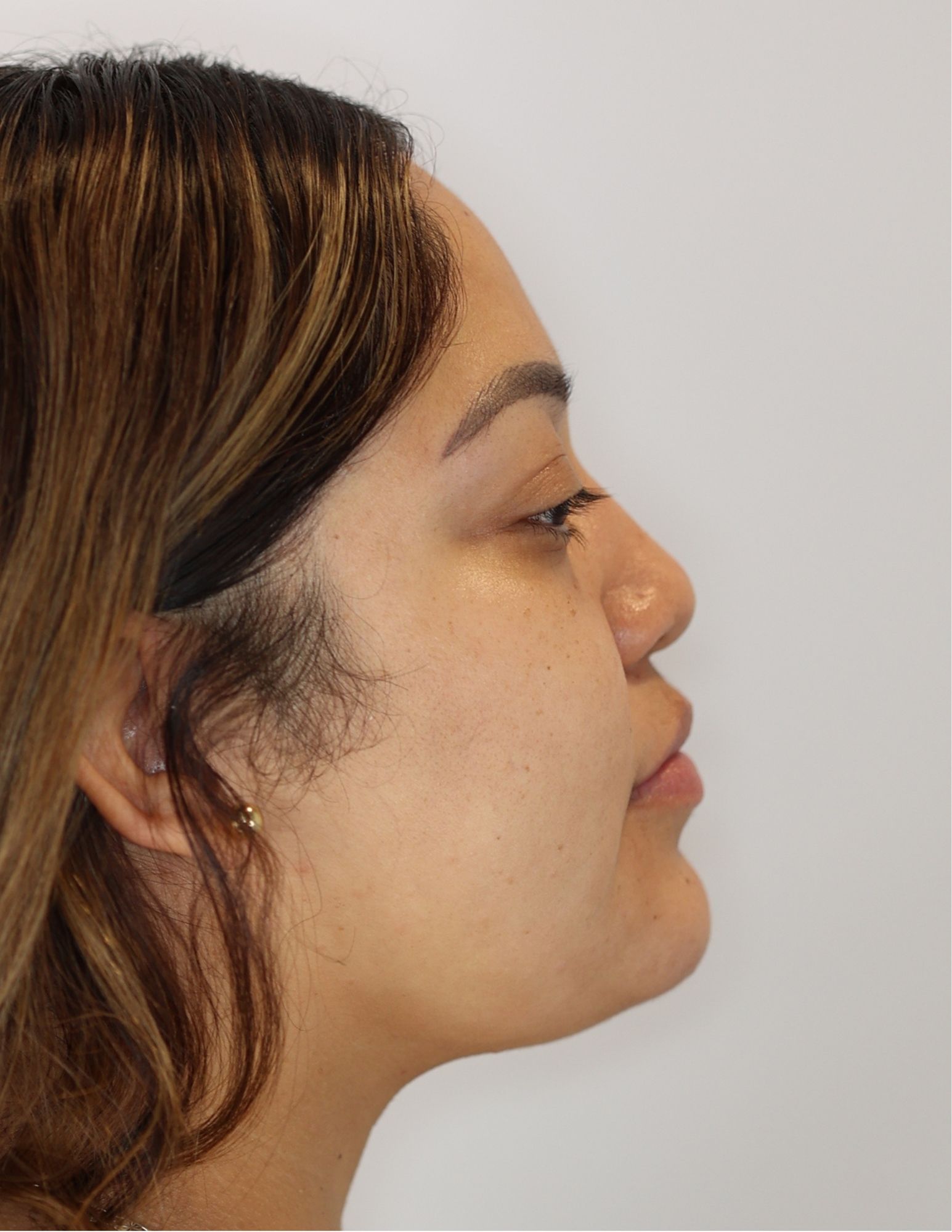 Neck (Chin) Liposuction