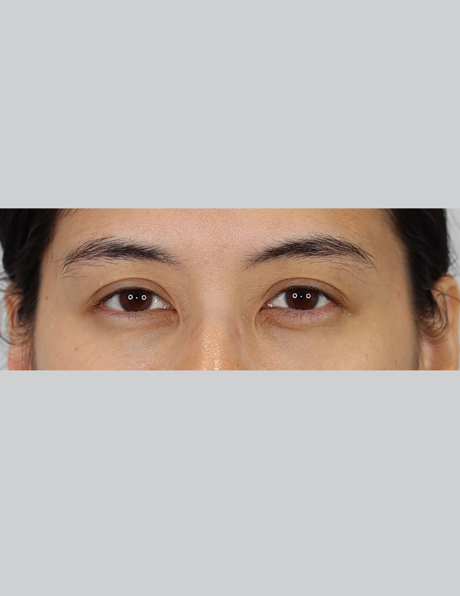 Upper Blepharoplasty (Eyelid Lift)