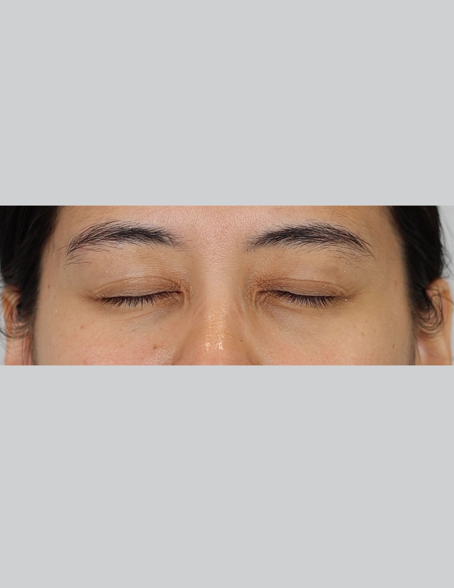 Upper Blepharoplasty (Eyelid Lift)