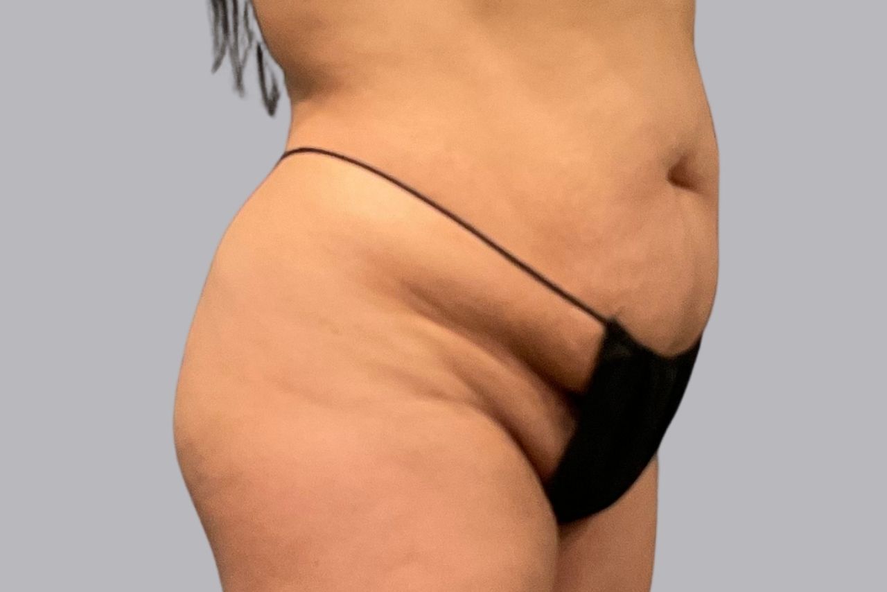 Fat Transfer to Buttocks (BBL)