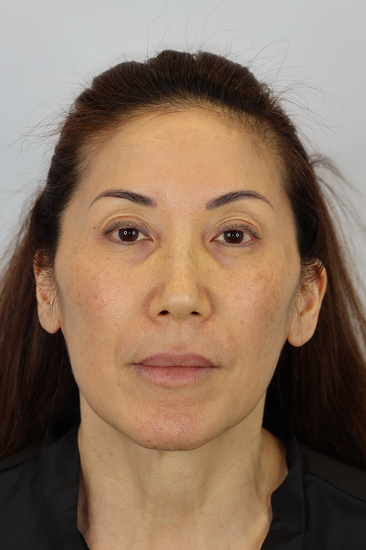 Upper Eyelid Lift (Upper Blepharoplast) with Ptosis Repair and Facial Fat Grafting