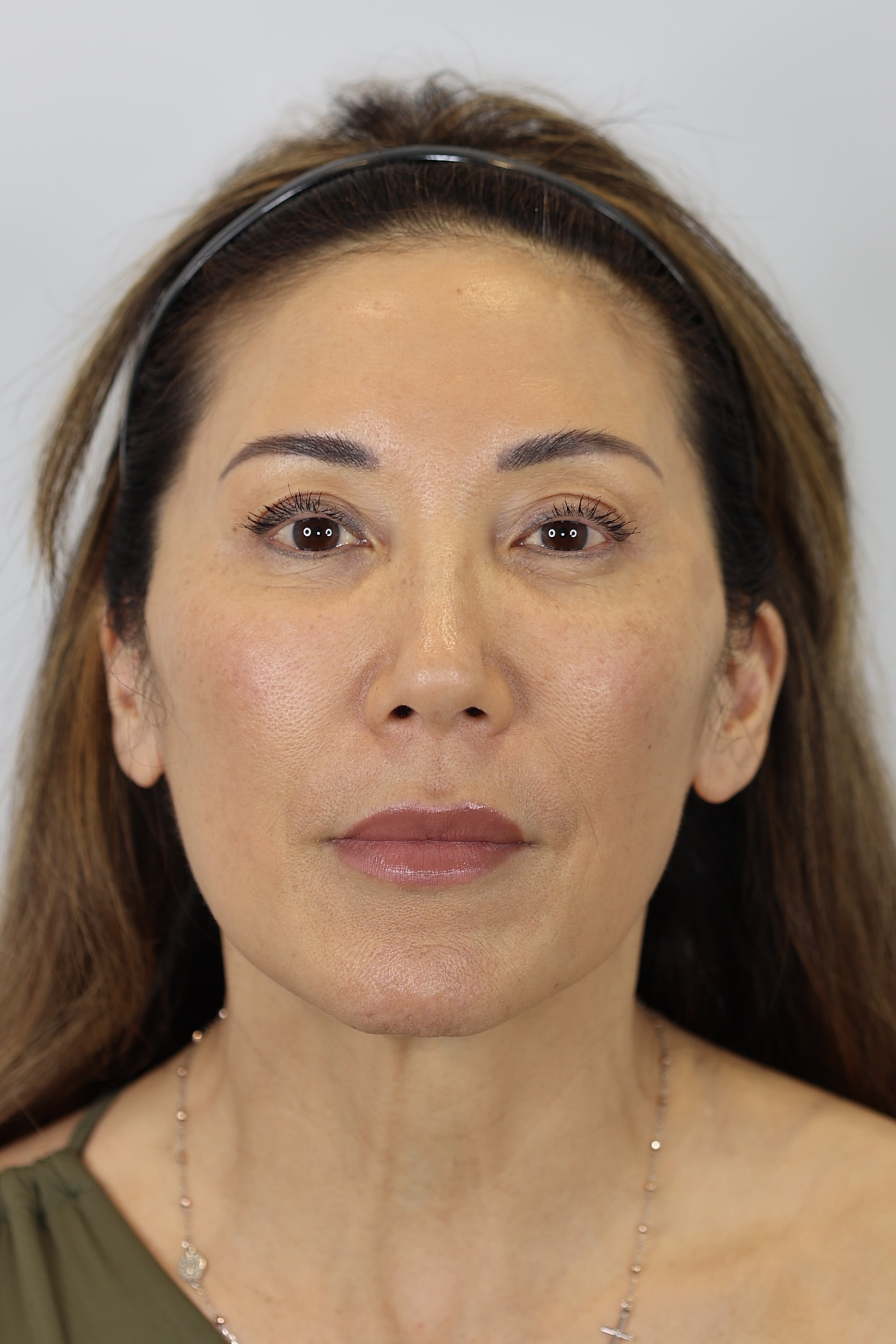 Upper Eyelid Lift (Upper Blepharoplast) with Ptosis Repair and Facial Fat Grafting