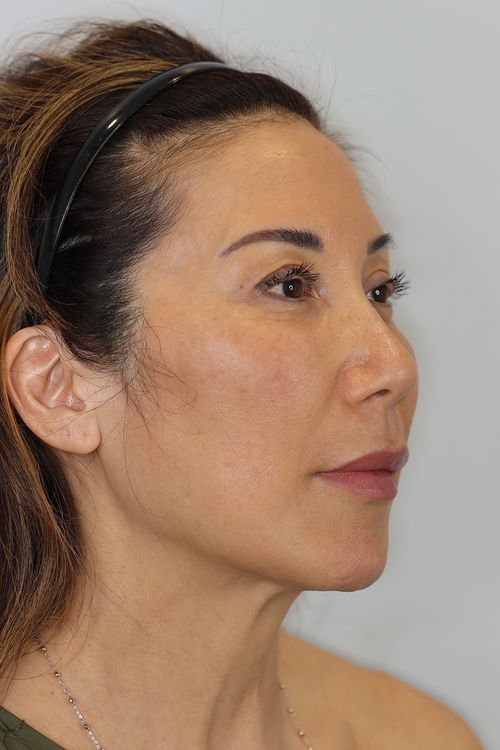 Upper Eyelid Lift (Upper Blepharoplast) with Ptosis Repair and Facial Fat Grafting