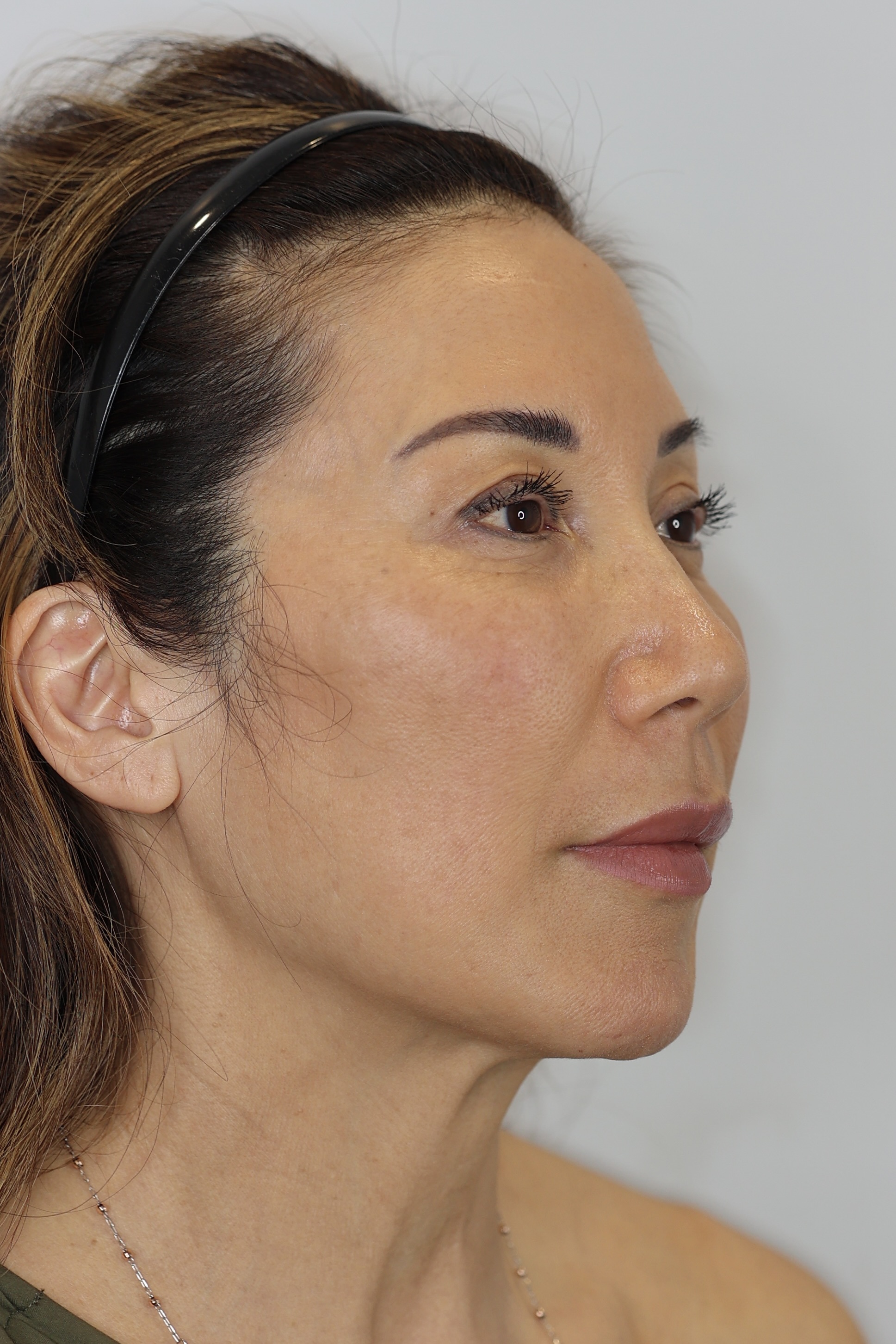 Upper Eyelid Lift (Upper Blepharoplast) with Ptosis Repair and Facial Fat Grafting