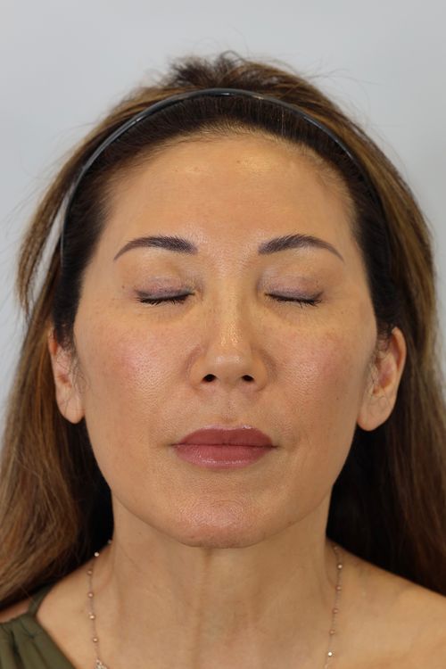 Upper Eyelid Lift (Upper Blepharoplast) with Ptosis Repair and Facial Fat Grafting