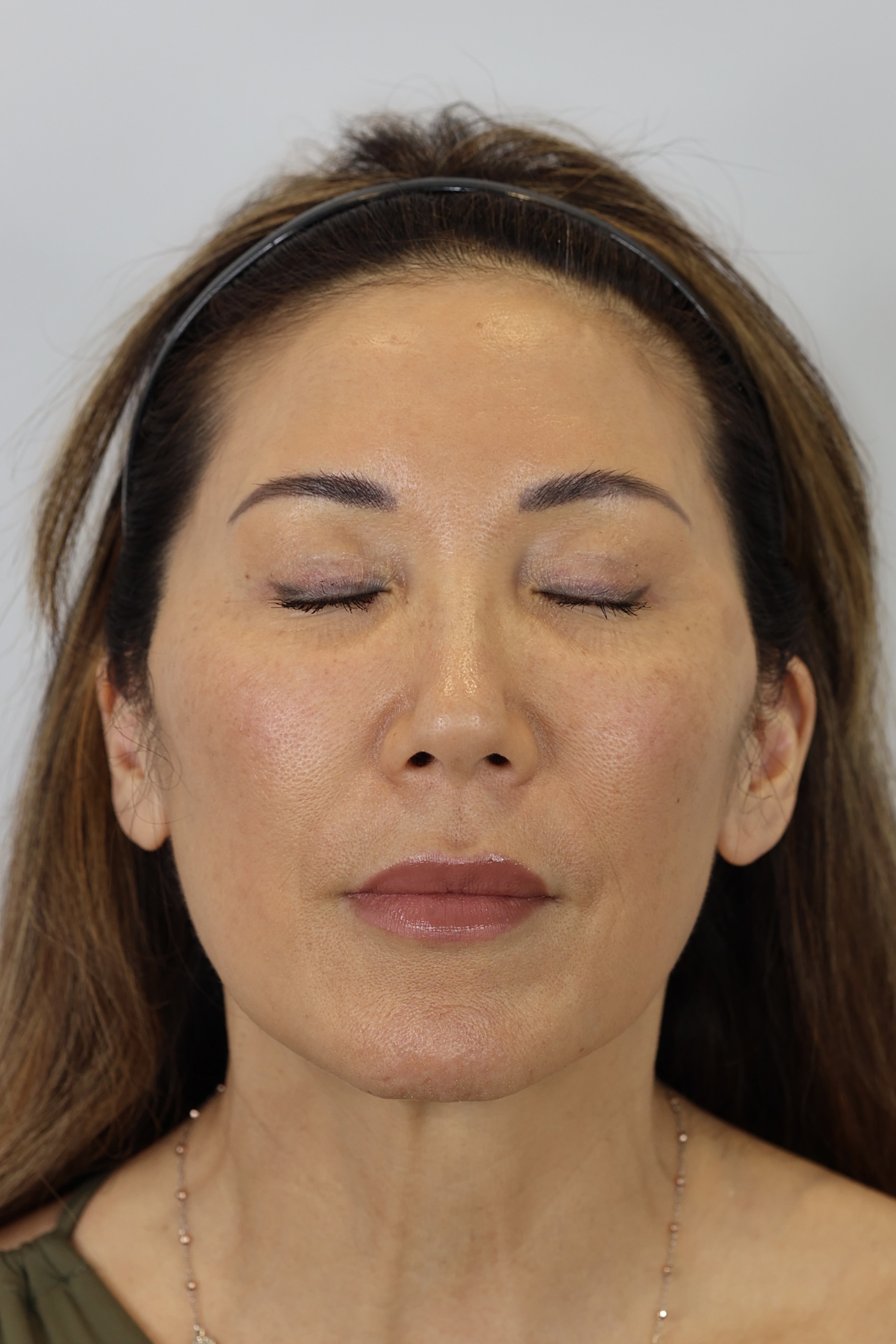 Upper Eyelid Lift (Upper Blepharoplast) with Ptosis Repair and Facial Fat Grafting