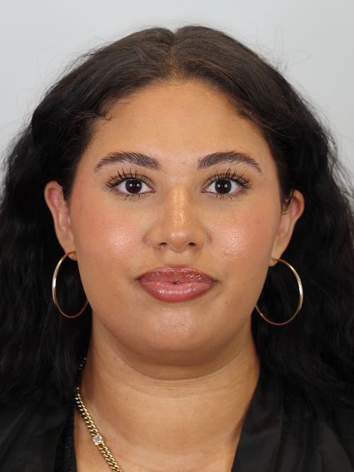 Chin and Neck Liposuction