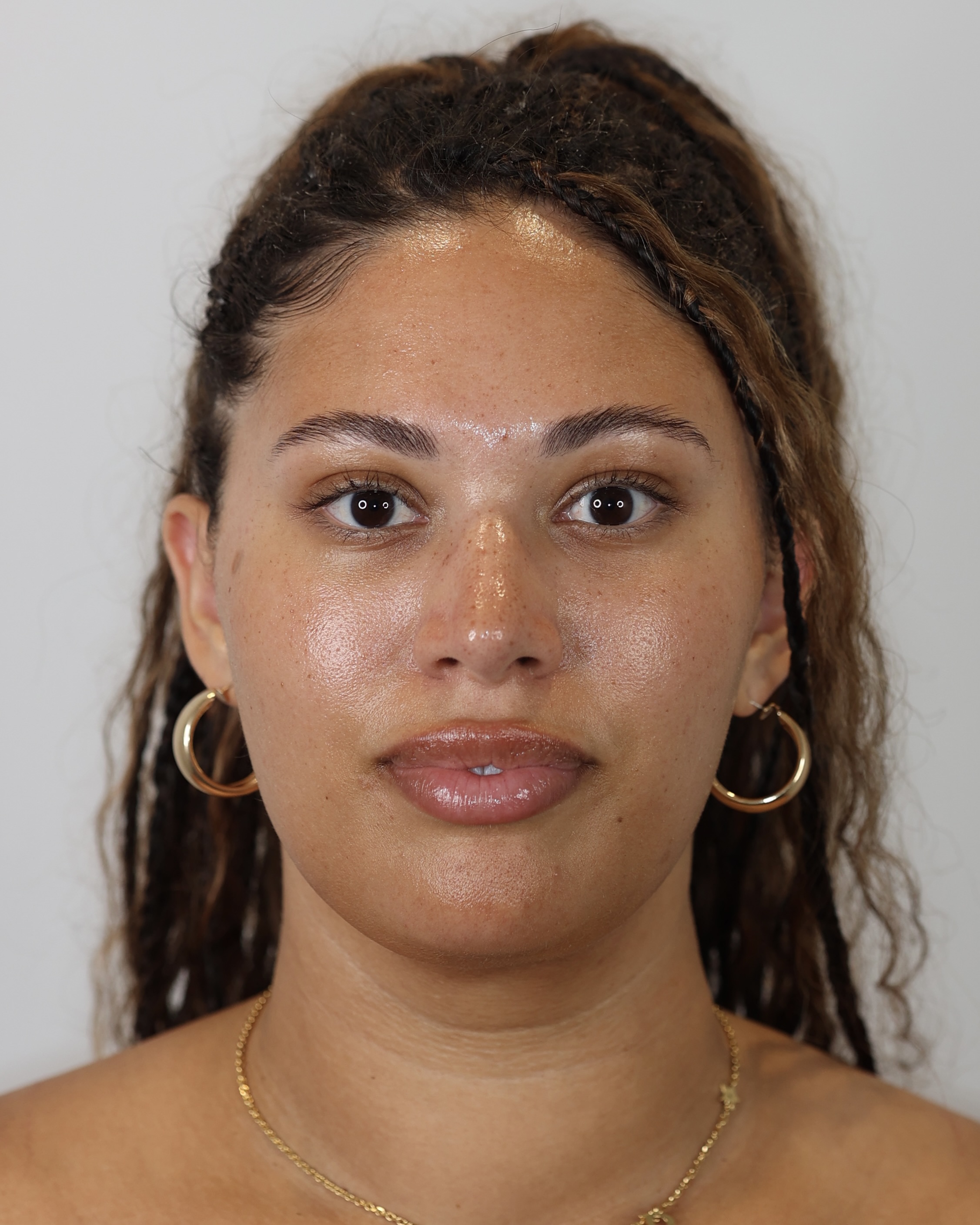Chin and Neck Liposuction