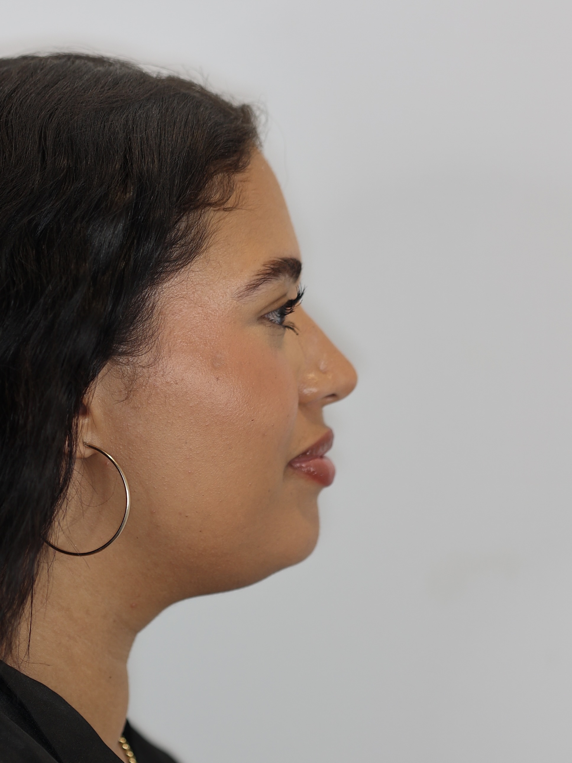Chin and Neck Liposuction