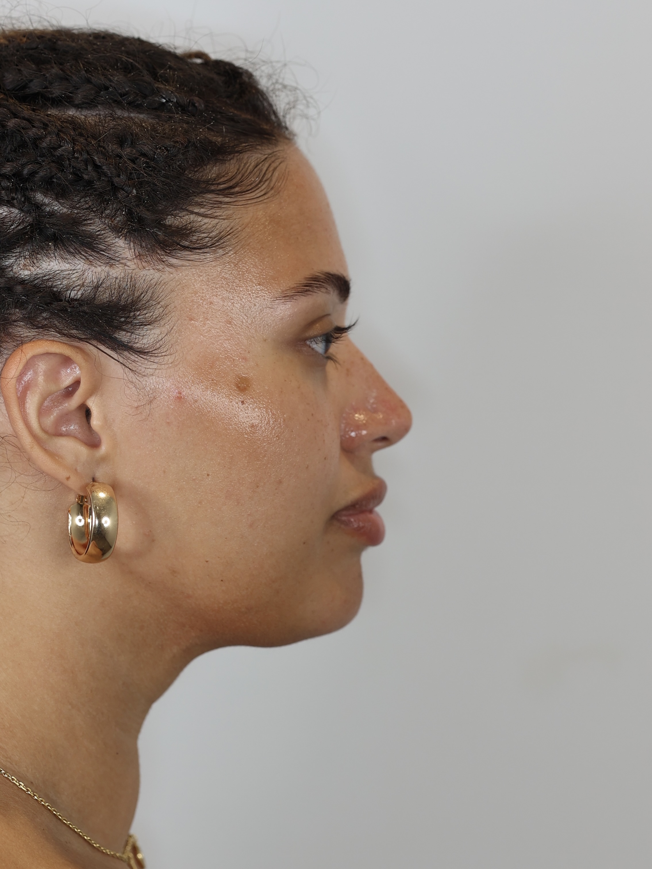 Chin and Neck Liposuction