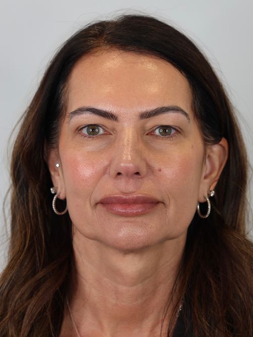 Upper Eyelid Lift (Upper Blepharoplasty) and Brow Lift