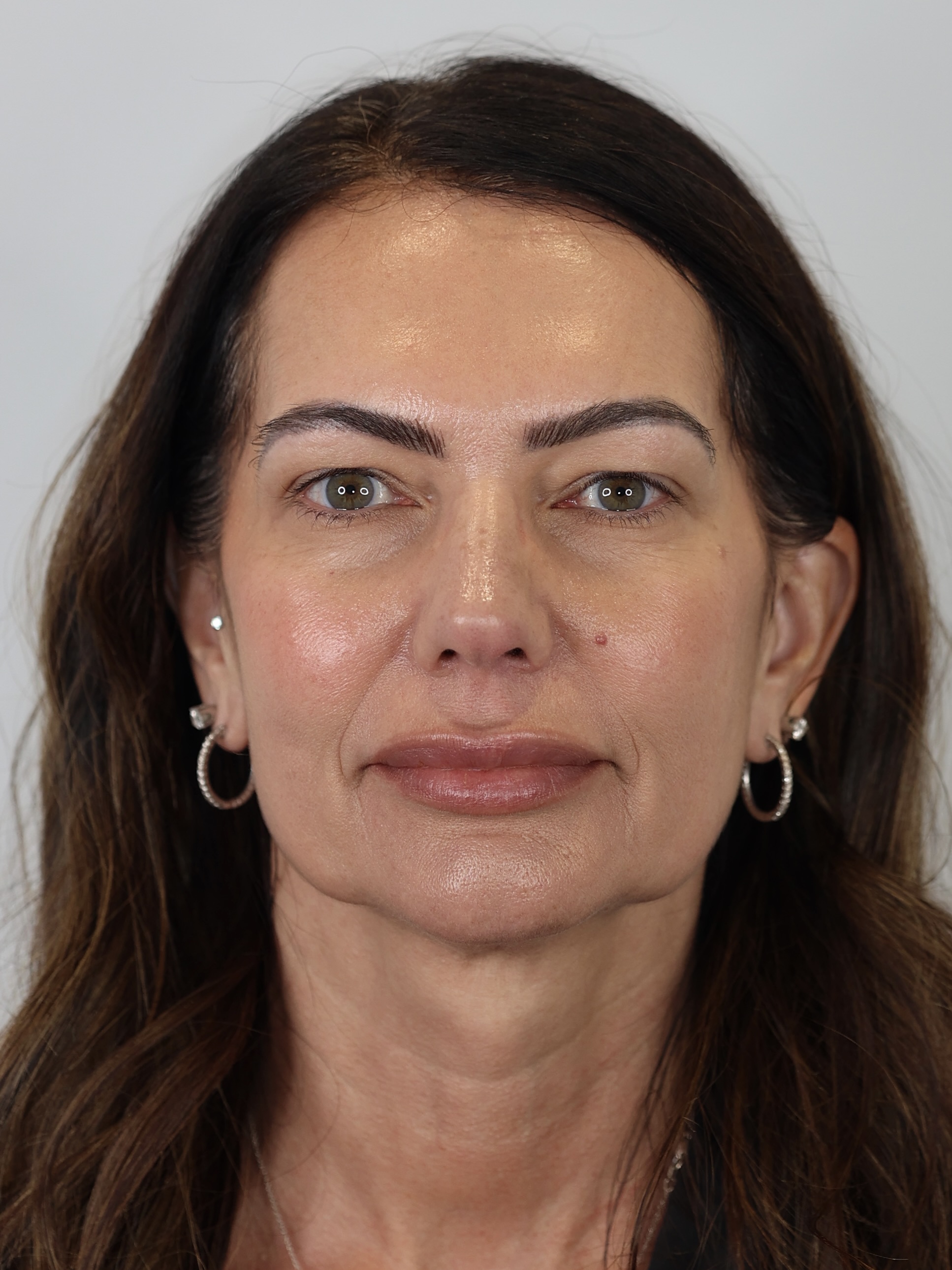 Upper Eyelid Lift (Upper Blepharoplasty) and Brow Lift