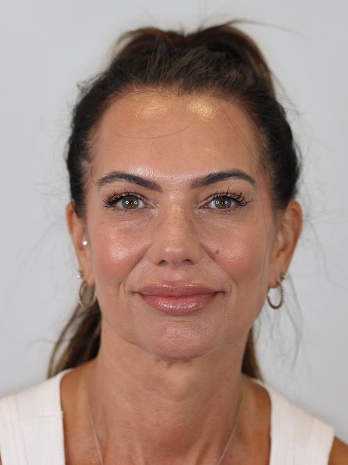 Upper Eyelid Lift (Upper Blepharoplasty) and Brow Lift