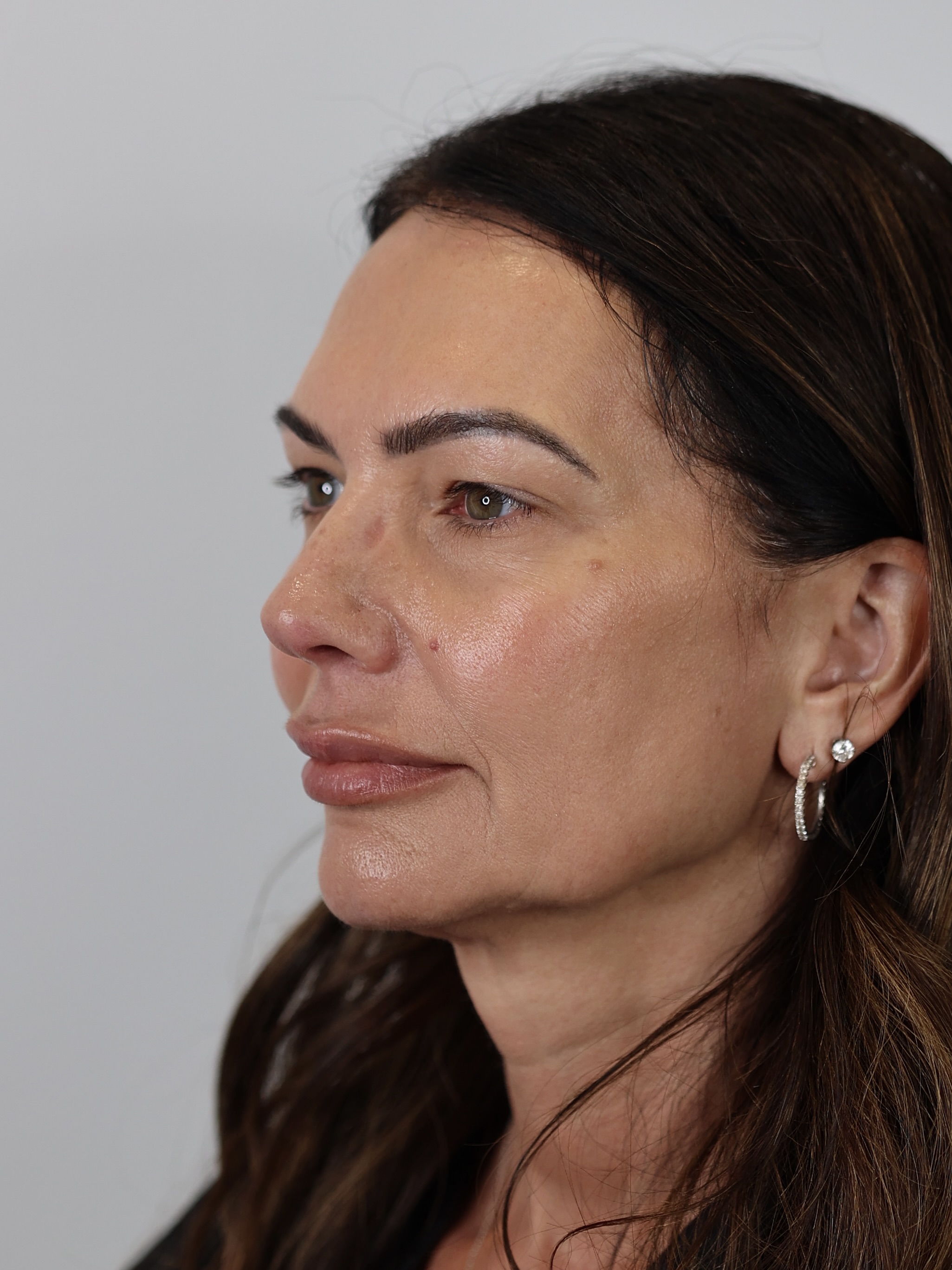Upper Eyelid Lift (Upper Blepharoplasty) and Brow Lift