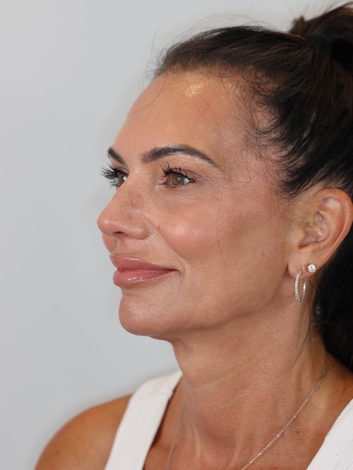 Upper Eyelid Lift (Upper Blepharoplasty) and Brow Lift