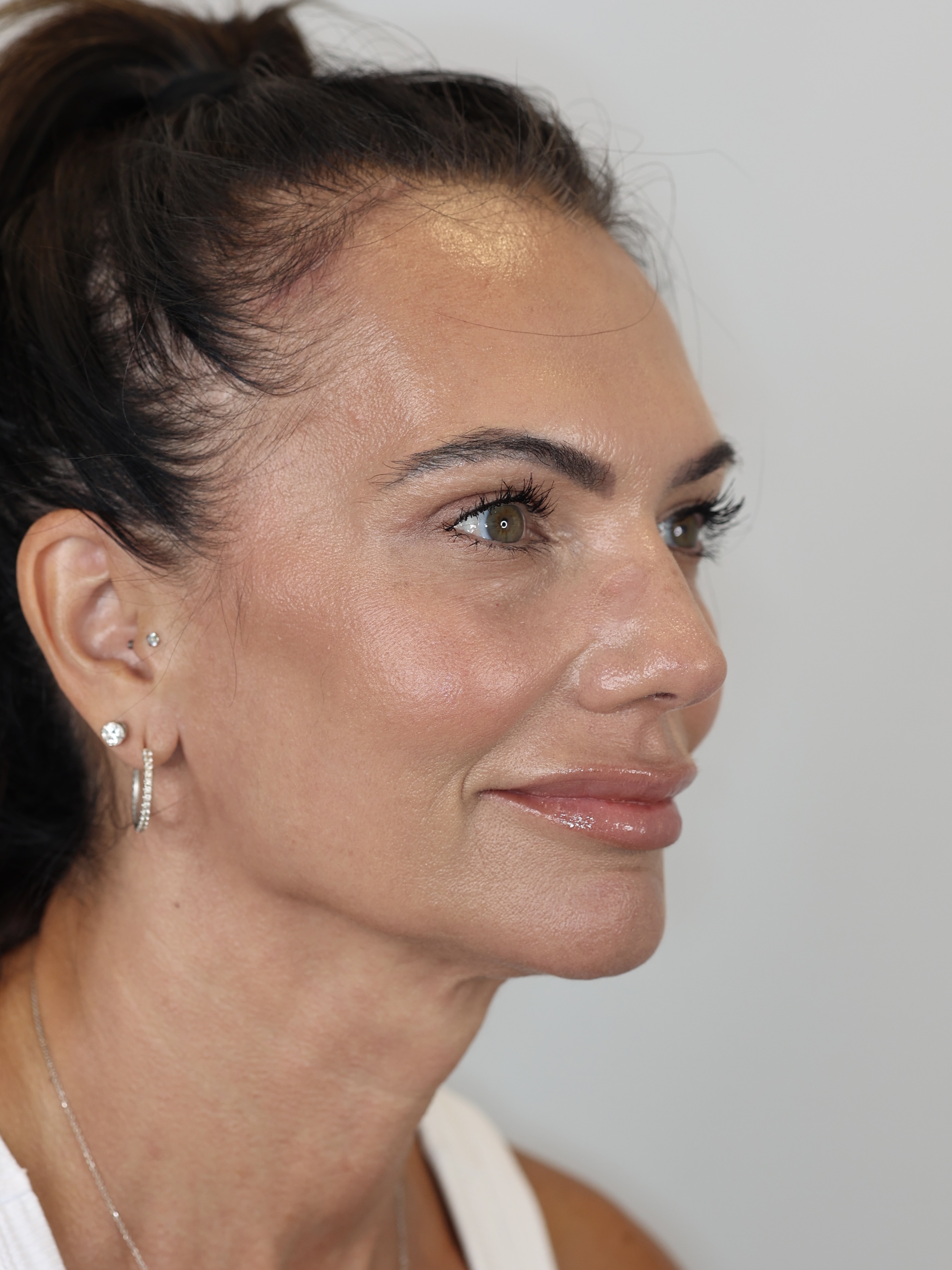 Upper Eyelid Lift (Upper Blepharoplasty) and Brow Lift