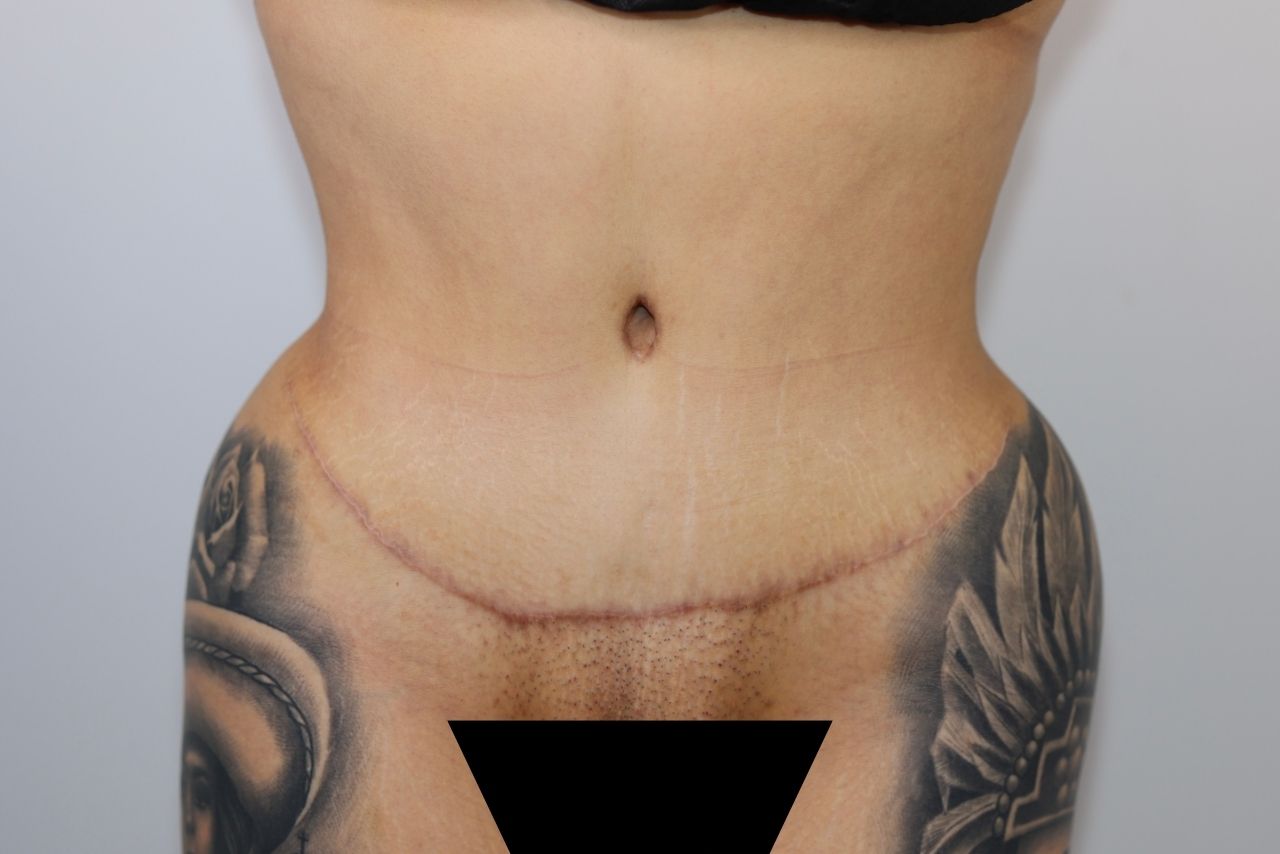 Tummy Tuck