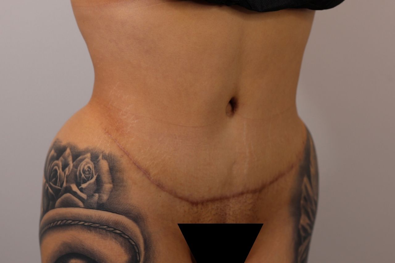 Tummy Tuck