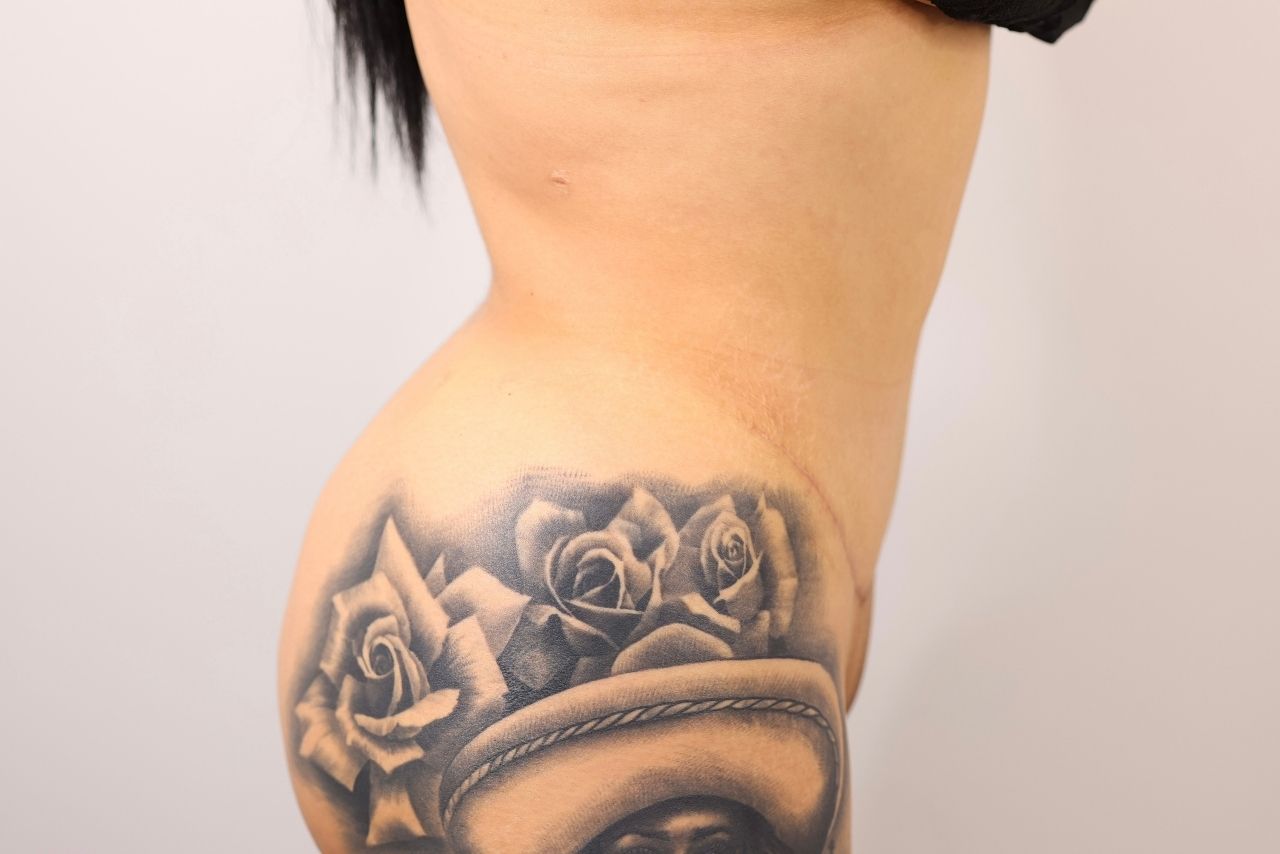 Tummy Tuck