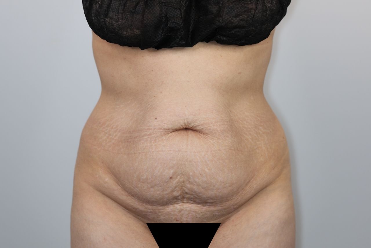 Tummy Tuck