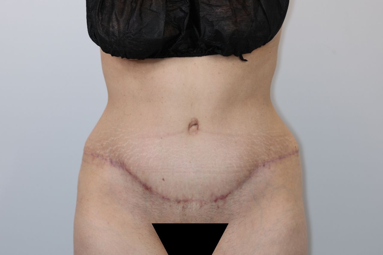 Tummy Tuck