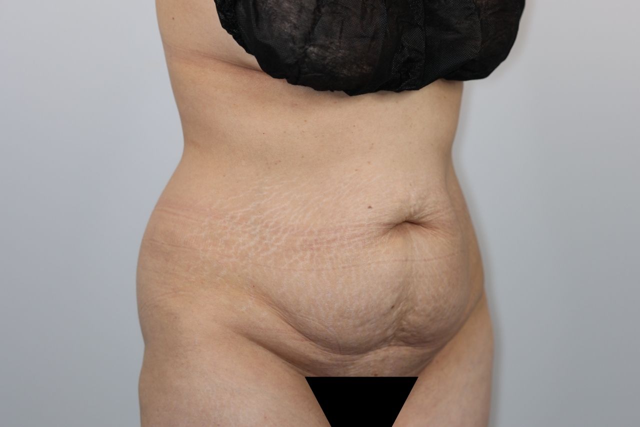 Tummy Tuck