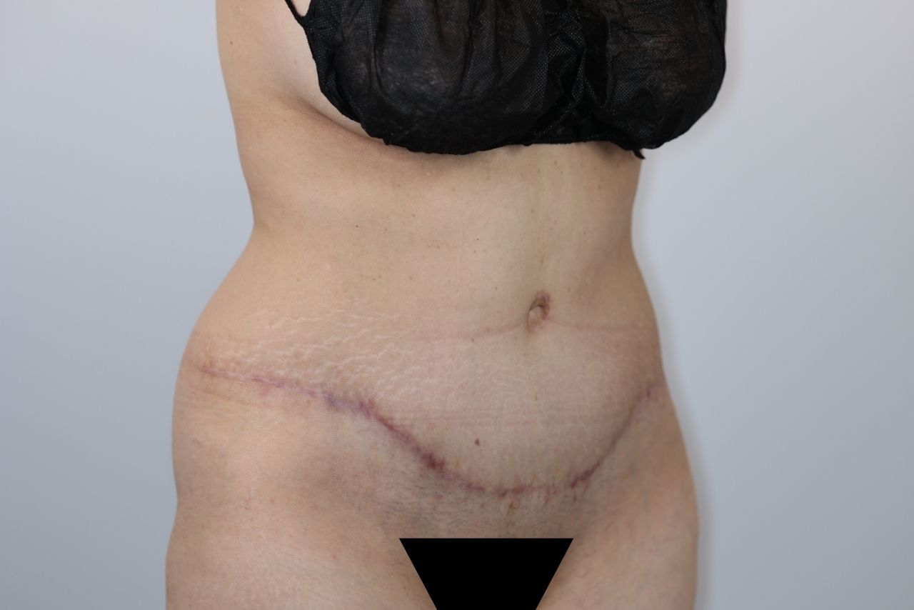 Tummy Tuck