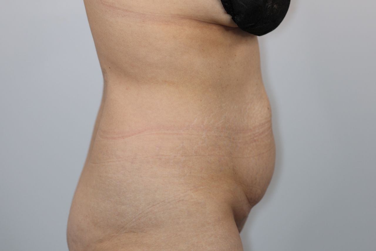 Tummy Tuck