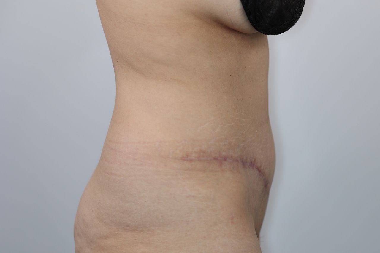 Tummy Tuck