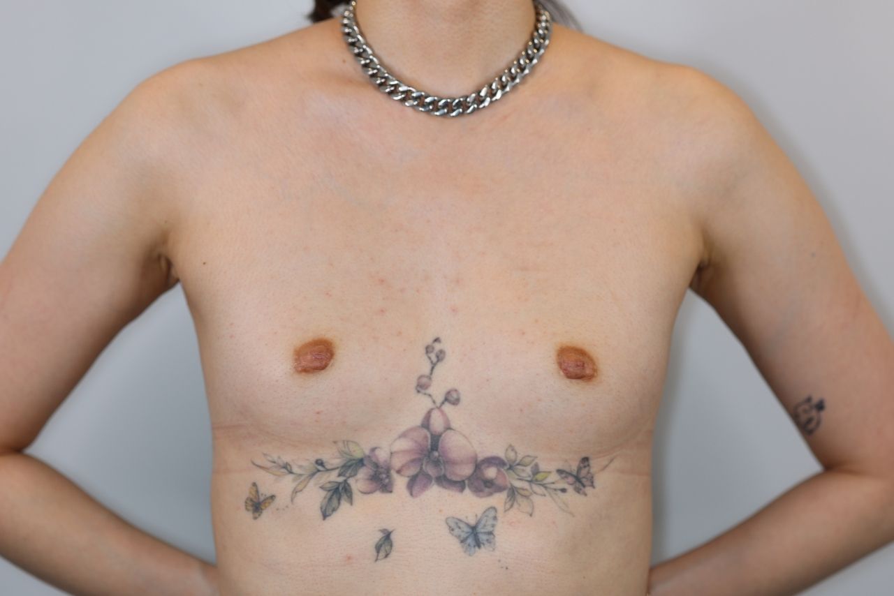 Breast Augmentation