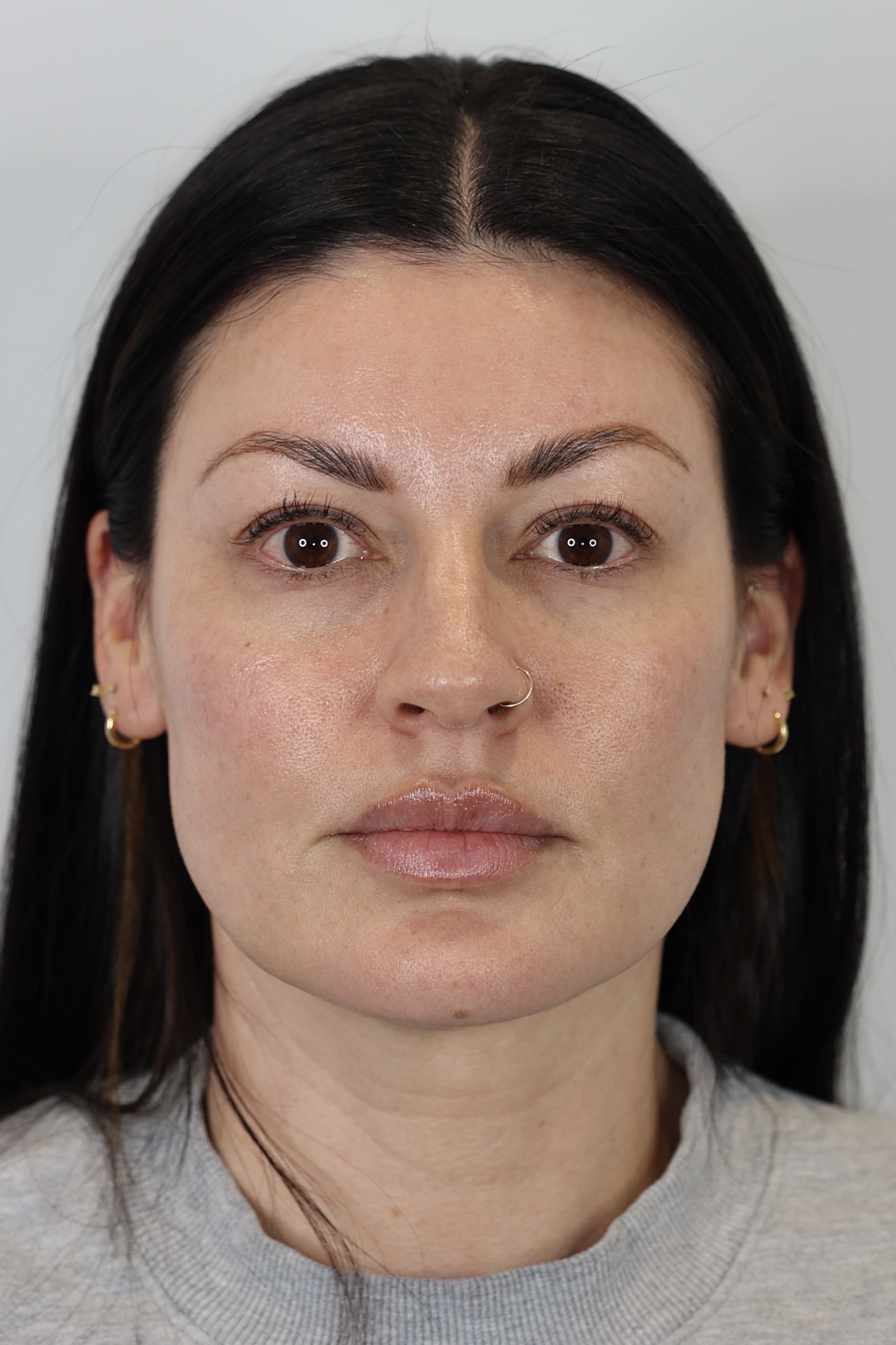 Upper Eyelid Lift (Upper Blepharoplast)