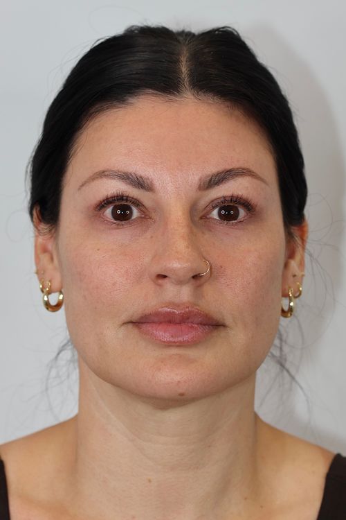 Upper Eyelid Lift (Upper Blepharoplast)