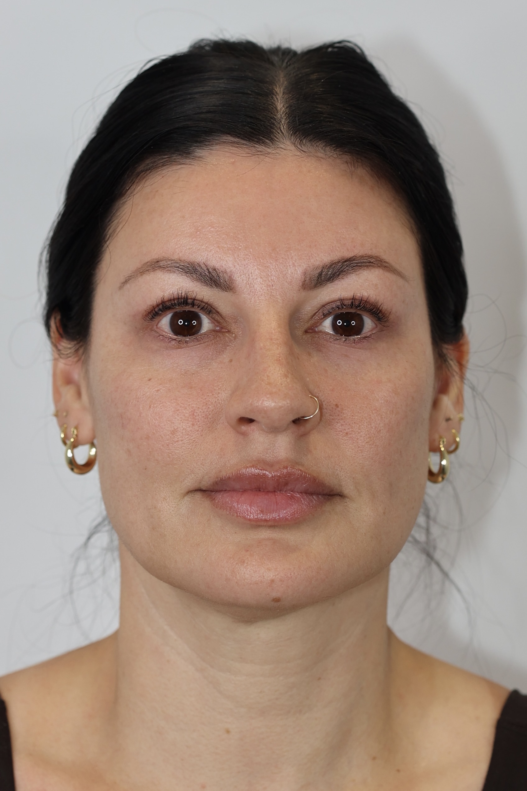 Upper Eyelid Lift (Upper Blepharoplast)