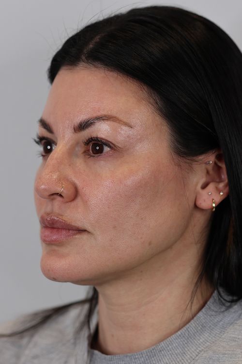 Upper Eyelid Lift (Upper Blepharoplast)