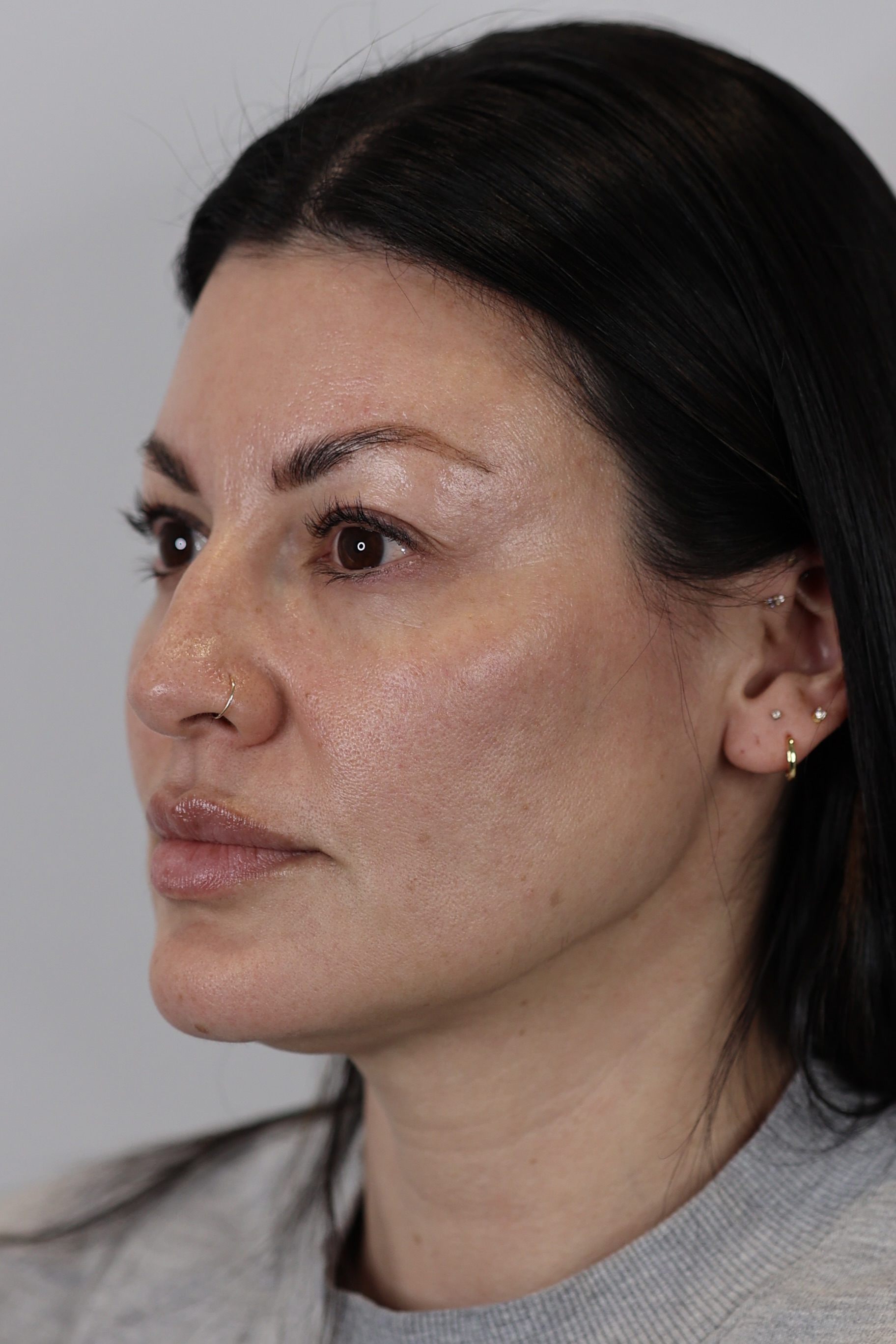 Upper Eyelid Lift (Upper Blepharoplast)