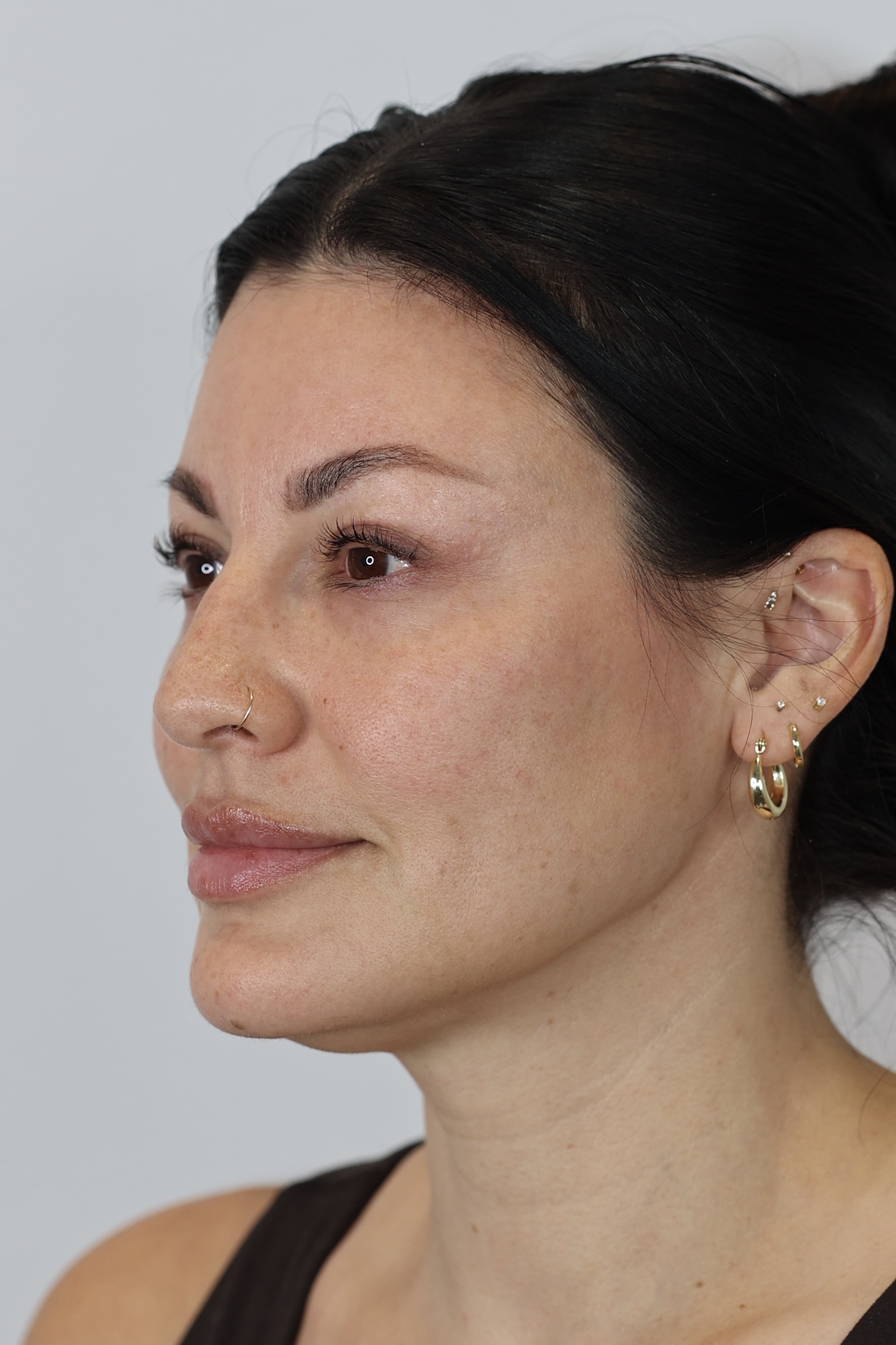 Upper Eyelid Lift (Upper Blepharoplast)