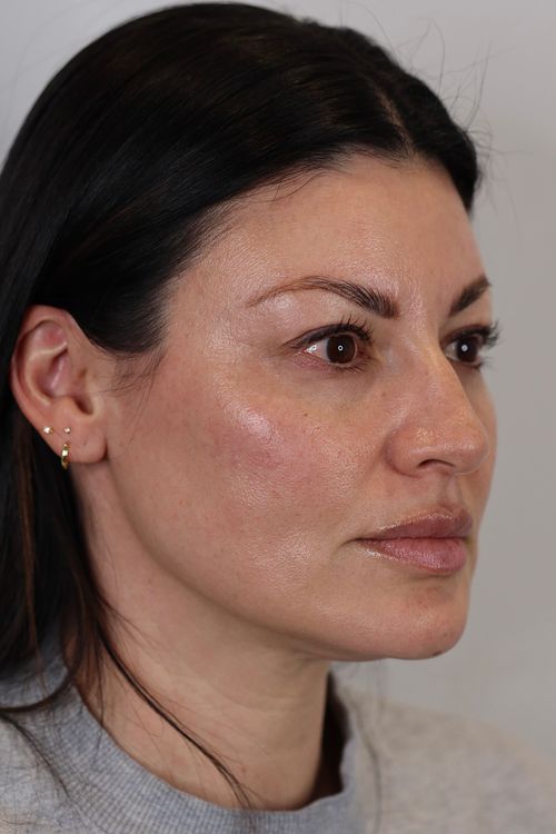 Upper Eyelid Lift (Upper Blepharoplast)
