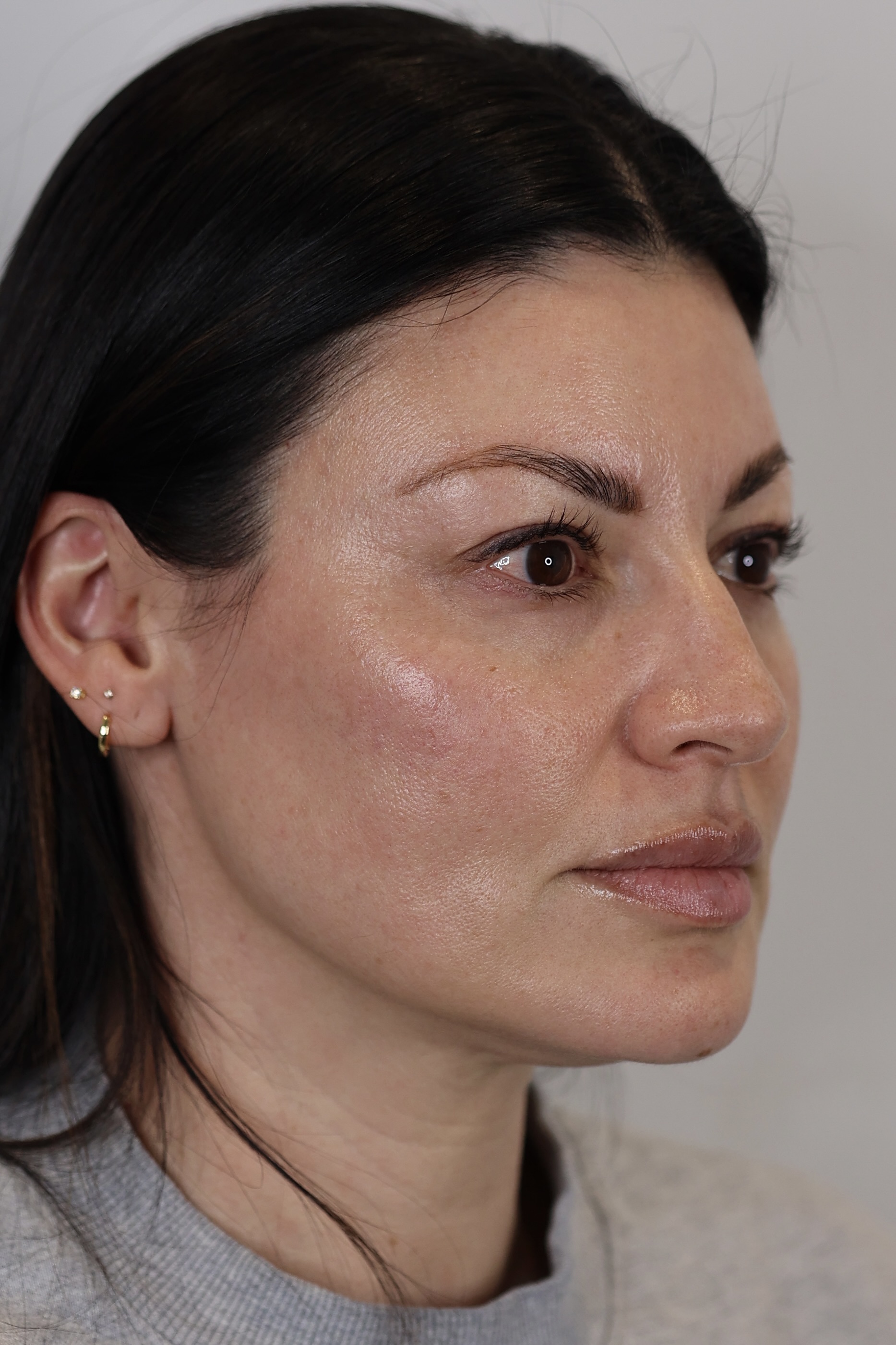 Upper Eyelid Lift (Upper Blepharoplast)