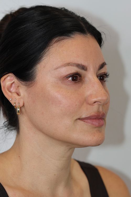 Upper Eyelid Lift (Upper Blepharoplast)