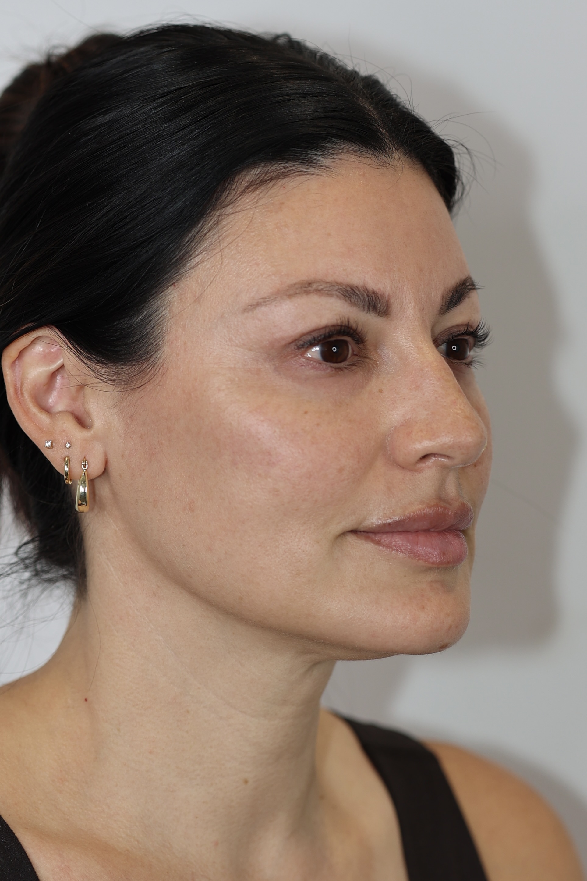 Upper Eyelid Lift (Upper Blepharoplast)