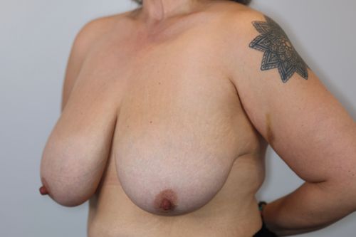 Breast Reduction