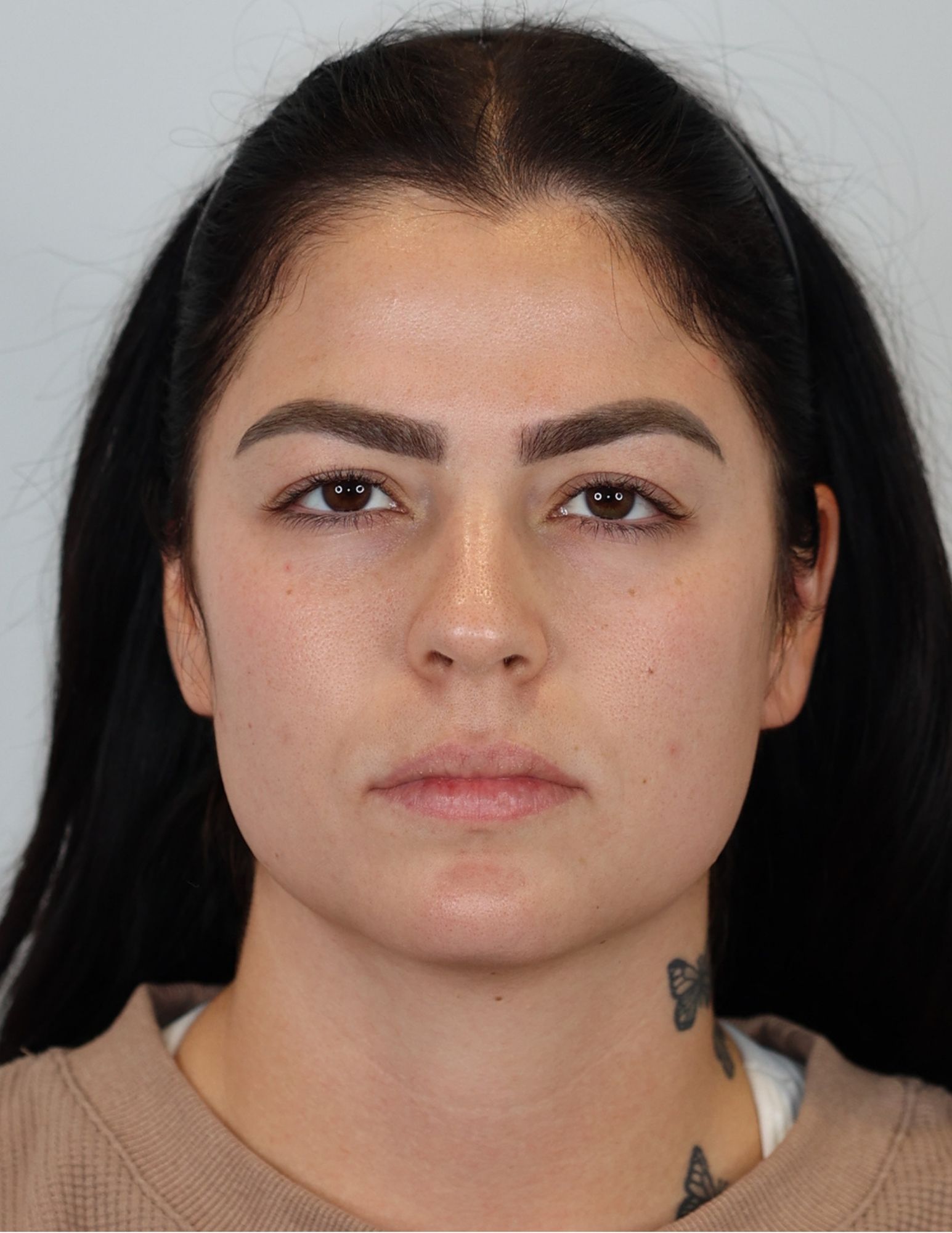 Upper Eyelid Lift (Upper Blepharoplasty)
