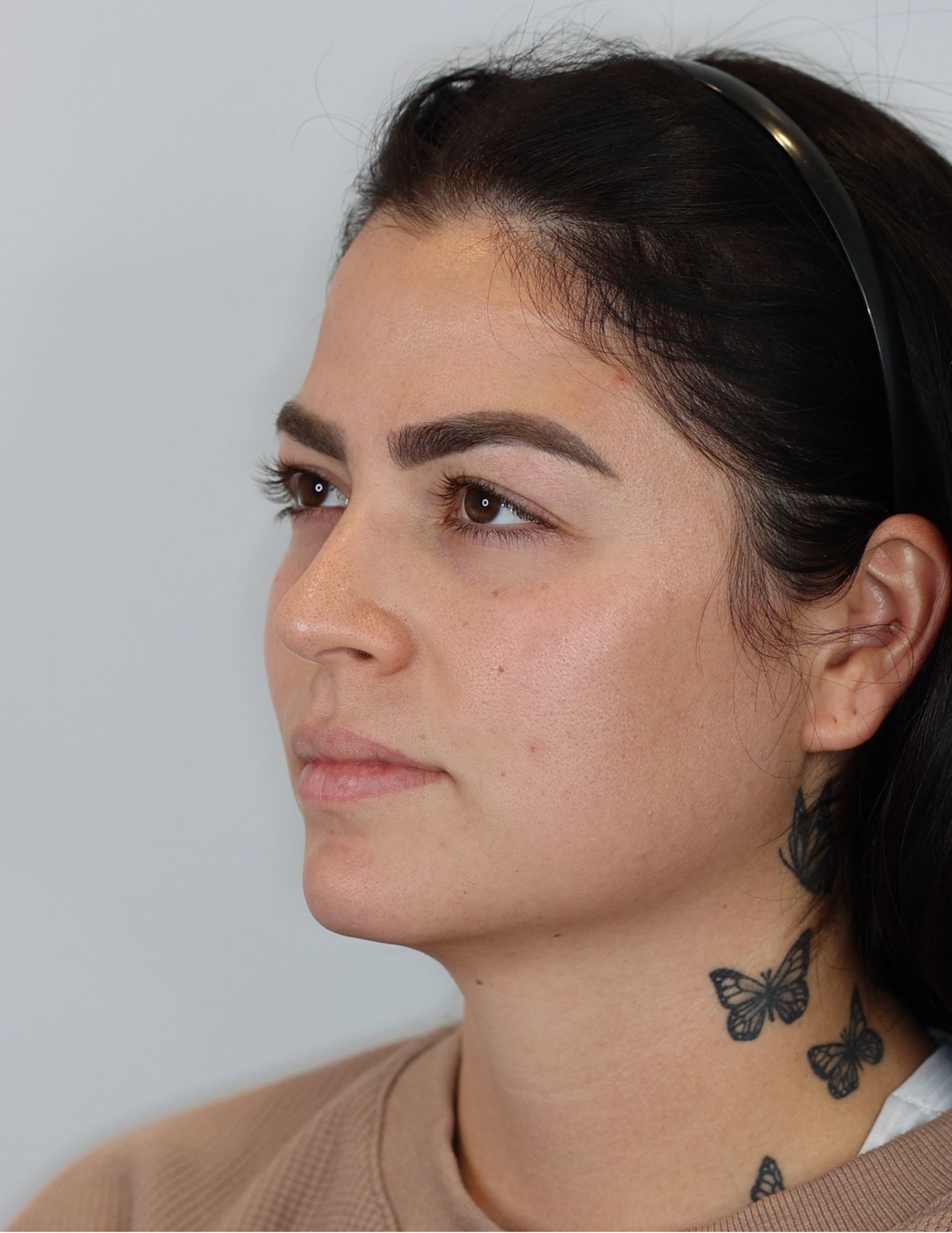 Upper Eyelid Lift (Upper Blepharoplasty)