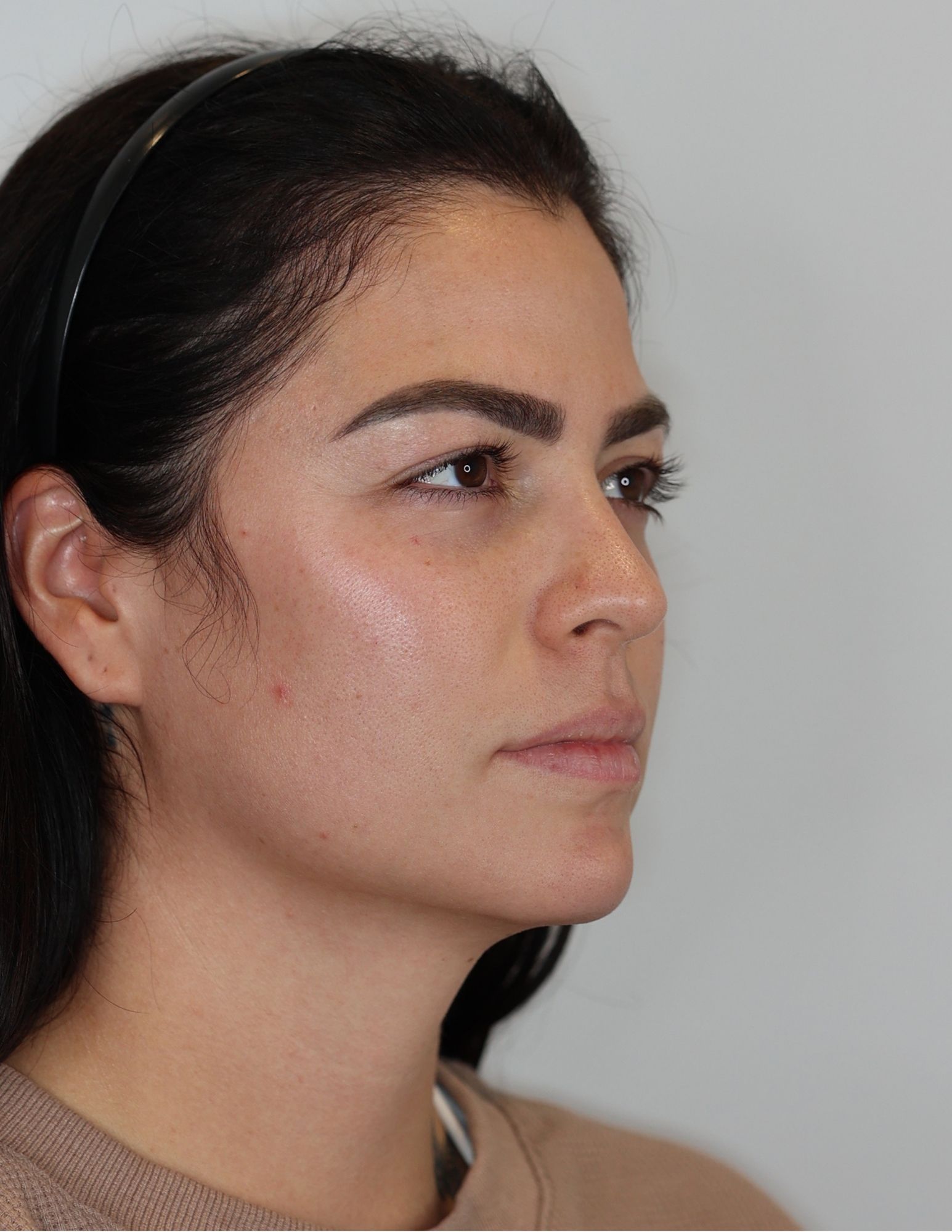 Upper Eyelid Lift (Upper Blepharoplasty)